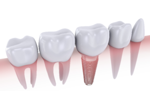 Understanding Dental Implants as a Whole