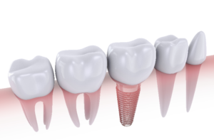 Understanding Dental Implants as a Whole